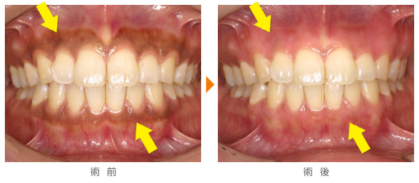 ガムブリーチ(歯肉の漂白)