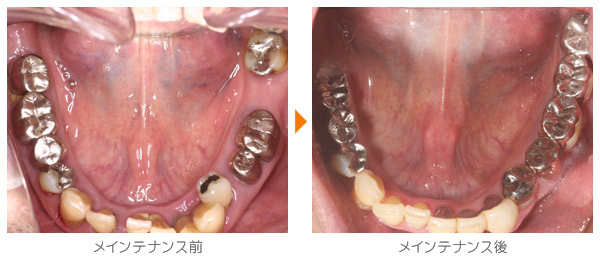 Ｍ・Ｋ様のメインテナンス症例