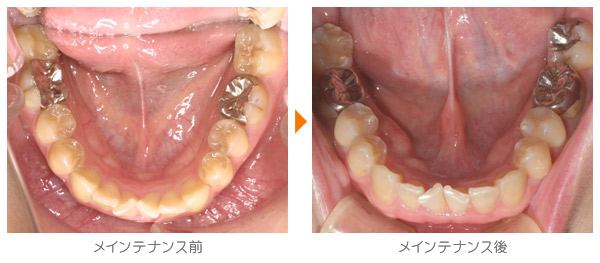 Ｙ・Ｍ様のメインテナンス症例