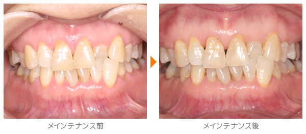 Ｙ・Ｎ様のメインテナンス症例