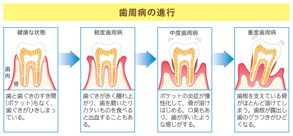 歯周病の進行