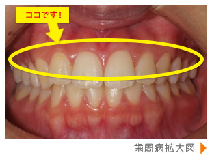 歯の写真