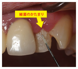 歯の細菌「プラーク」