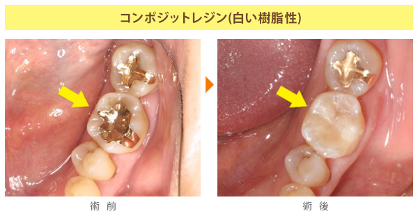 コンポジットレジン